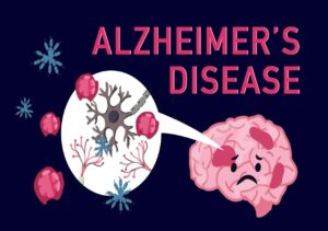 بیماری آلزایمر Alzheimer’s disease چیست؟